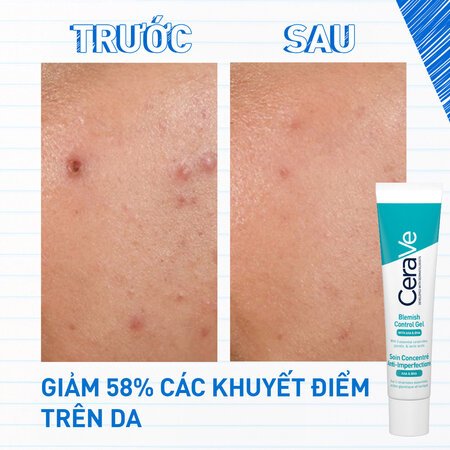 Gel Giảm Mụn Cerave Mờ Thâm, Thu Nhỏ Lỗ Chân Lông 40ml 06