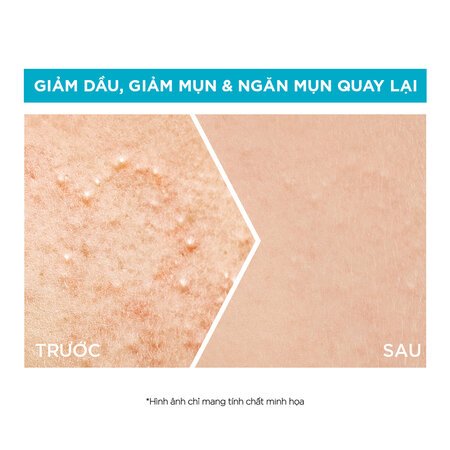 Serum Garnier Giảm Mụn Mờ Thâm Cho Da Dầu, Mụn 15ml 04